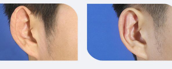 上饒哪家韓式雙眼皮醫(yī)院專業(yè)且值得信賴的推薦？