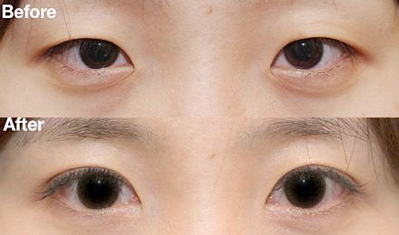 2023深圳黃金微針去除口周紋醫(yī)生綜合實力排行榜(鄭瑜璠、吳曉玲、劉彤大勢醫(yī)美重磅來襲)