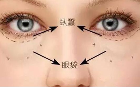 海口哪家醫(yī)院做眼袋效果好？