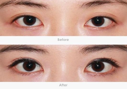 深圳哪家專業(yè)去黑眼圈機(jī)構(gòu)靠譜？