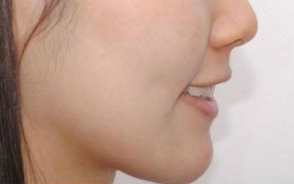 成都藝星周順波與陳遠坤鼻子整形實力對決！術(shù)前比較，看誰更擅長鼻子！