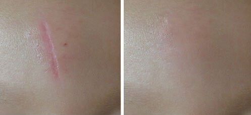 鄭州哪家醫(yī)院激光做的好？找尋專業(yè)！領先的鄭州醫(yī)院激光治療推薦