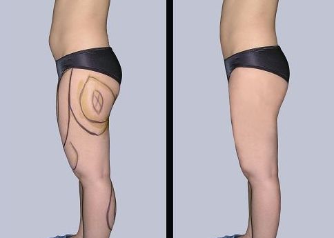 合肥哪家醫(yī)院可以有效治療腋臭問題？