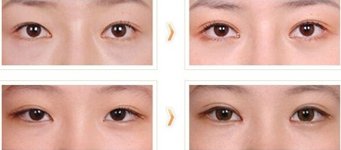 2023南陽眼鼻修復(fù)再造大型專家(陳保國(guó)、李穎、黃立新技術(shù)厲害收費(fèi)還不坑)