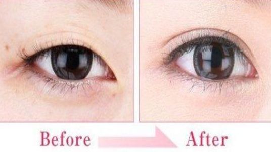 蘇州雙眼皮哪家做的好？專業(yè)攻略與醫(yī)師推薦