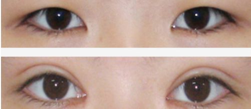 上海祛痘坑的醫(yī)院哪家好？讓你遠離痘痘困擾的專業(yè)醫(yī)院有哪些？