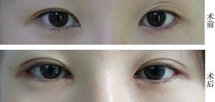 福州抽脂大腿哪家醫(yī)院好？挑選福州最靠譜的抽脂醫(yī)院有哪些？