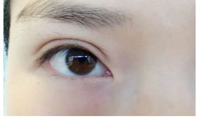 南昌祛痘哪家醫(yī)院口碑好，效果最佳？