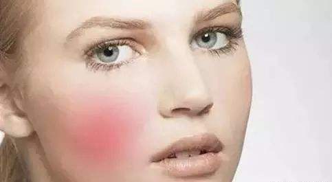 沈陽(yáng)杏林醫(yī)生張瑩瑩治療雙眼皮修復(fù)效果如何？附真實(shí)網(wǎng)友高清修復(fù)前后對(duì)比圖