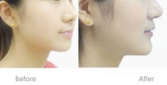 蘇州嘴唇改薄哪家醫(yī)院好？專業(yè)的整形醫(yī)院推薦