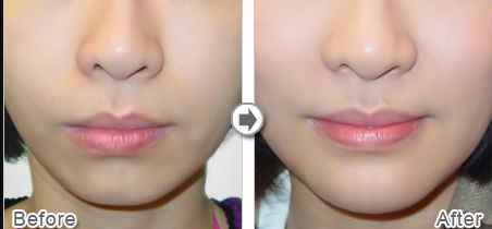 上海做雙眼皮哪家好醫(yī)院？專家評(píng)選2023年最佳雙眼皮醫(yī)院