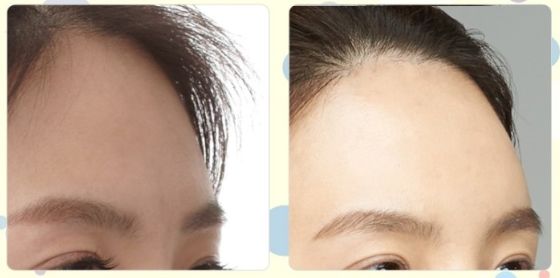 南京最好的祛痘醫(yī)院是哪家？揭秘南京治療痘痘首選醫(yī)院