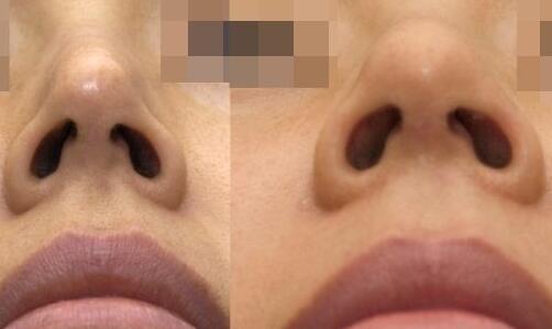 靳小雷雙眼皮修復(fù)手術(shù)的完美案例分享，期待您的見證