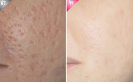 杭州做雙眼皮哪家好？2023年杭州雙眼皮整形醫(yī)院綜合排名指南拆解