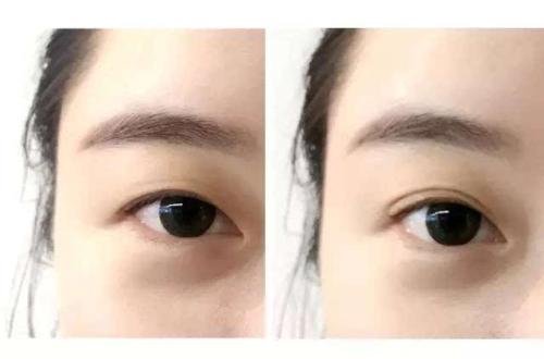 2023青島胸部假體取出手術排名榜前十醫(yī)生(郭華、趙宏武、張思浩技術實力好！放心選~)