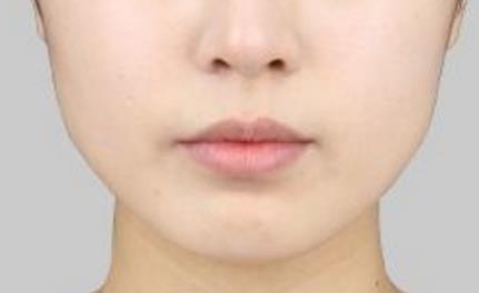 2023甘肅鼻背寬矯正術(shù)強(qiáng)榜前十的醫(yī)生(歷國媛、劉俊玲、陳志芳口碑出色)