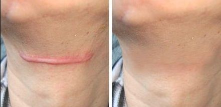 杭州市疤痕醫(yī)院哪家好？無痕祛疤，專業(yè)技術(shù)讓你恢復(fù)自信！