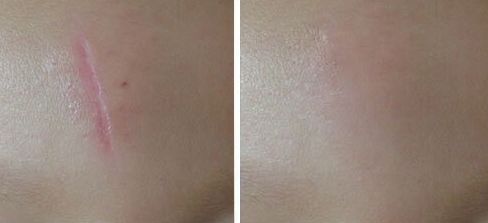 西安雙眼皮手術(shù)最佳推薦，哪家醫(yī)院技術(shù)好？