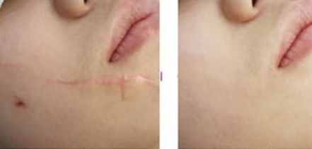 福州激光祛色斑哪家好？了解福州激光祛斑的優(yōu)秀機(jī)構(gòu)推薦！