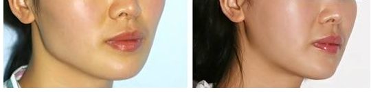 合肥假體隆胸哪家醫(yī)院好？術(shù)后效果如何？