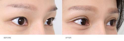 上海整容醫(yī)生推薦：讓您擁有完美鼻型，變身肋骨鼻！