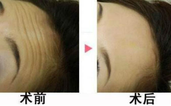 何晉龍的鼻型經(jīng)歷：立體挺拔，妥妥側(cè)顏殺！