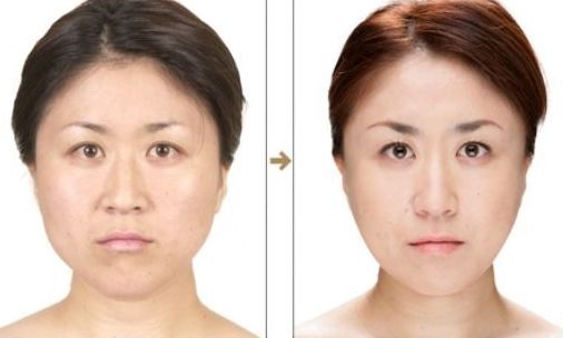 杭州整形醫(yī)院的抽脂效果如何？哪家醫(yī)院抽脂好？