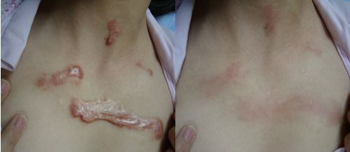 廣州市治療疤痕效果好的醫(yī)院有哪些？