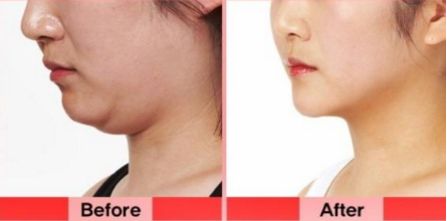 洛陽(yáng)雙眼皮修復(fù)哪家好？挑選專(zhuān)業(yè)技術(shù)實(shí)力強(qiáng)的醫(yī)療機(jī)構(gòu)