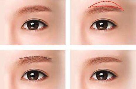 北京馮斌脂肪填充手術(shù)效果分析及相關(guān)費用查詢