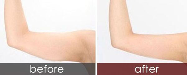 長春狐臭手術(shù)哪家醫(yī)院最專業(yè)？選擇哪家醫(yī)院治療狐臭效果好