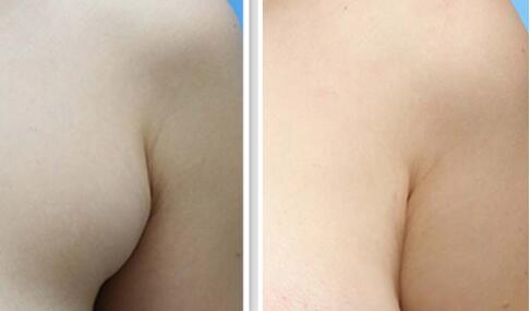 深圳北大何君君墊下巴案例分享，細節(jié)透露驚艷效果