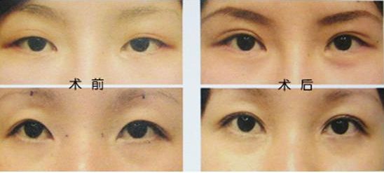 揭秘佛山哪家整形醫(yī)院吸脂好？導(dǎo)醫(yī)全解析、患者口碑高，信賴(lài)度高！