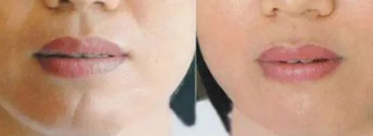 上海面部除疤效果最好的醫(yī)院有哪些？