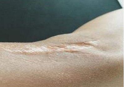 深圳治痘坑哪家醫(yī)院好？推薦有口碑的專業(yè)去痘項目醫(yī)院