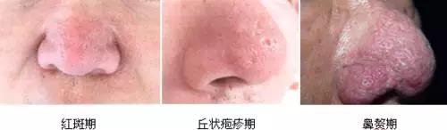 解密楊杰雙眼皮修復(fù)失敗案例圖，讓你心中的期望成為現(xiàn)實(shí)！