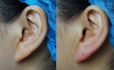 洛陽手術(shù)疤痕去除哪家好？選擇靠譜專業(yè)的洛陽疤痕修復(fù)中心