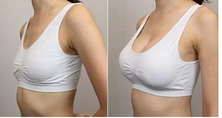 廣州脂肪隆胸醫(yī)生技術(shù)高超，手術(shù)效果自然倍受贊譽(yù)