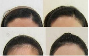 哈爾濱皮秒手術(shù)哪家醫(yī)院好？全面評測哈爾濱皮秒醫(yī)院排名