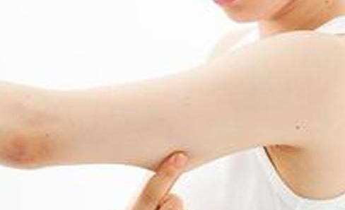 南昌文輝才雙眼皮：恢復(fù)速度神奇！