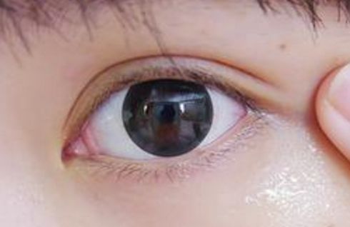 山東割眼袋哪家醫(yī)院好？眼袋手術(shù)山東醫(yī)院哪家專業(yè)靠譜？