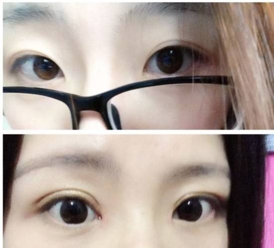 2023黃石小切口去頸部皺紋前十強專家排名(韓斌、余秋芬、陳杰深受當(dāng)?shù)厝耸肯矏?