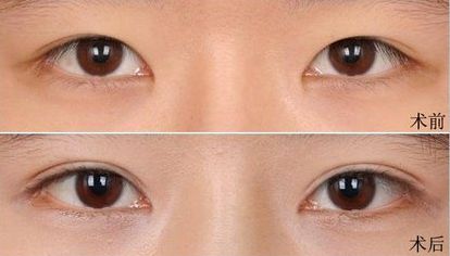 大連假體隆鼻哪家醫(yī)院好？打造完美鼻型，這家醫(yī)院是最佳選擇！