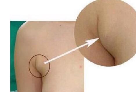 張誠教授為您的雙眼皮修復(fù)提供完美解決方案！成功案例分享，糾正雙眼皮失敗的救星~