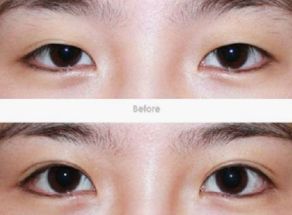 昆明哪家醫(yī)院的隆鼻整形效果好？