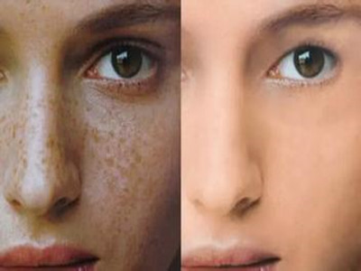 2023北京光子去雀斑排行榜前10名的醫(yī)生(武崇高、王凱瀠、邢志花在榜內(nèi))