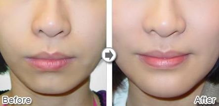 武漢熱瑪吉技術(shù)治療最好的醫(yī)院是哪家？