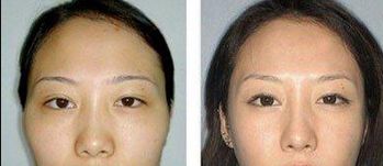 重慶去眼袋哪家醫(yī)院好？選擇靠譜的醫(yī)療機構(gòu)，功效更可靠！