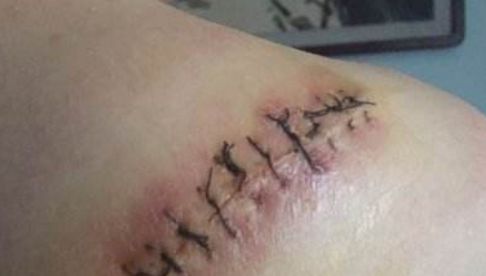 信陽哪家醫(yī)院祛痘效果好，專家推薦去哪家醫(yī)院治療痘痘？