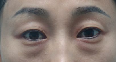 天津醫(yī)院去疤膏效果好的有哪些？